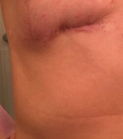 ribgraft.jpg