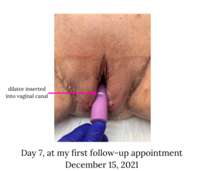 day 7 - dec 15 - dilator inserted.png