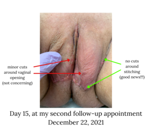day 15 - vulva with minor cuts.png