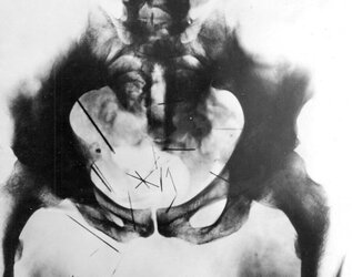 needles-in-pelvis-of-albert-fish.jpg