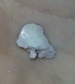 Tonsil_stones1.jpg