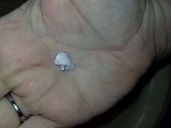 Tonsil_stones2.jpg