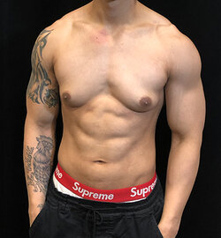 gynecomastia.jpg