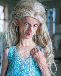 Progeria.jpg