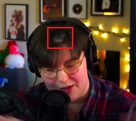 EmmysMalePatternBaldness.jpg