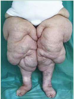 severe lipolymphedema, W.J. Brauer MD, hanse-klinik.png