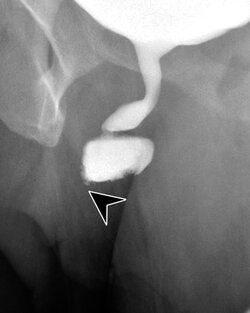 aiden complete occlusion 1.jpg aiden complete occlusion 1.jpg