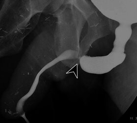 aiden stenosis 1.jpg