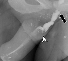 aiden stenosis 2.jpg