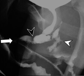 aiden fistula and stenosis.jpg