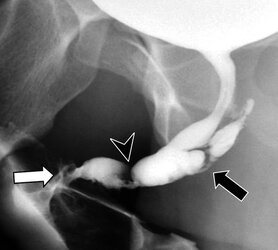 aiden fistula and stenosis 2.jpg
