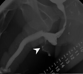 aiden delayed fistula.jpg