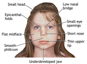 fetal-alcohol-syndrome-1.jpg