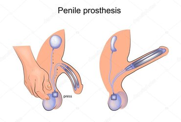depositphotos_160091280-stock-illustration-penile-prosthesis-urology[1].jpg