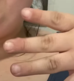 wart 2.PNG