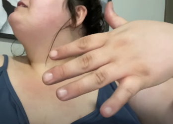wart.PNG