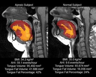 Apneic Tongue.jpg