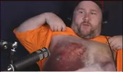 hematoma 1.png