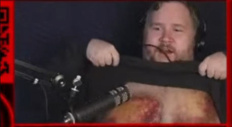 hematoma 2.PNG