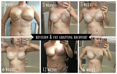 revision-and-fat-grafting-recovery-with-dates[1].jpg