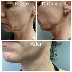 BLOG-Plasmapen-before-after.jpg