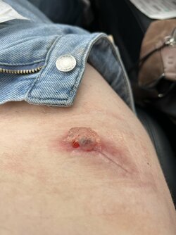 hip infection 3.jpg