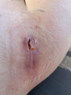hip wound 3.jpg