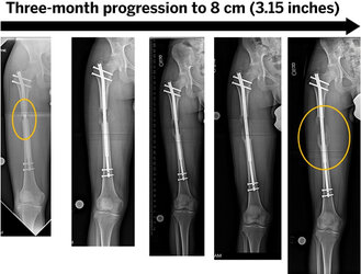 x-ray-osteotomy-femur-limb-lengthening-8-cm-percutaneous-approach.jpg