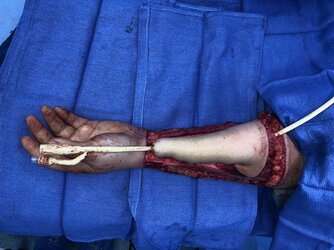 Tubed-radial-forearm-flap-for-phalloplasty-construction-prior-to-flap-transfer.jpg