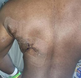 The-patients-donor-site-is-shown-10-months-postoperative-following-a-left-latissimus.jpg