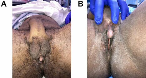 A-and-B-Patient-is-shown-4-months-following-insertion-of-silicone-testicular-implants.jpg