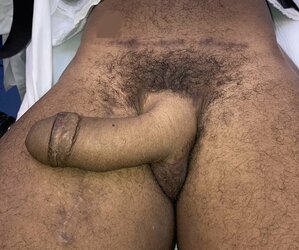 Patient-3-months-postoperatively-with-viable-neophallus-using-a-split-lateral-latissimus.jpg