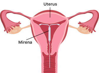 Mirena-Placement-Diagram-2-567x0-c-default.png