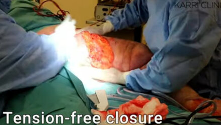 Lymphoedema-debulking-surgery.jpg