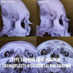 Tyep3Cranioplasty.jpg