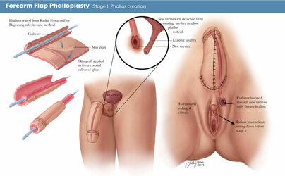 phalloplasty-1.jpg