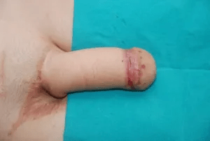 Penis-Gorseli-2.png