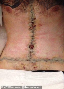 LA Man - Skin Removal Scars PostOp 01.jpg