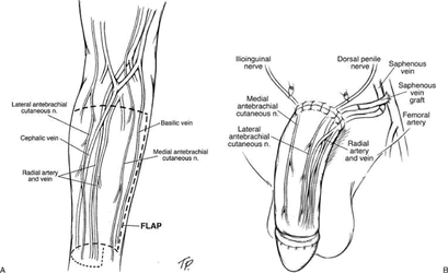 rff-phalloplasty.gif