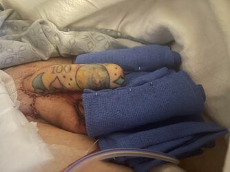 one-day-post-op-rff-phalloplasty-v0-affobjy7e6t91.jpg