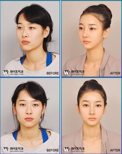 before after korean surgery.jpg