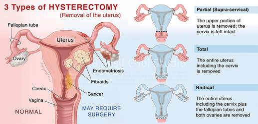 InsilC_72_3-types-of-Hysterectomy[1].jpg