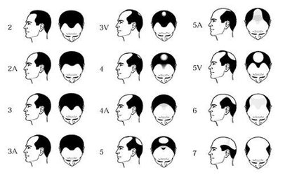 Norwood-Scale-for-Male-Pattern-Hair-Loss-2363807384.jpg