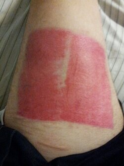 07-thigh-selfharm-scars.jpg