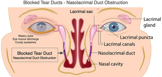 Tear-Duct-Obstruction-[1].jpg