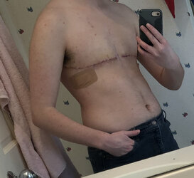 topsurgery1week.jpg