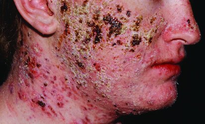 acne_fulminans_photo1_web.jpg