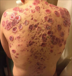 acne-fulminans.jpg