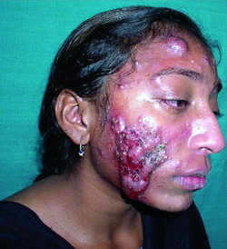 376b_conglobate_acne_01_springer_high.jpg
