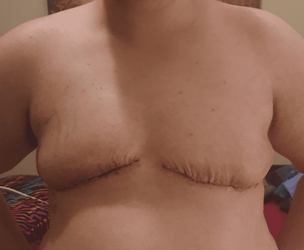1_Week_Postop_Cropped(2).png